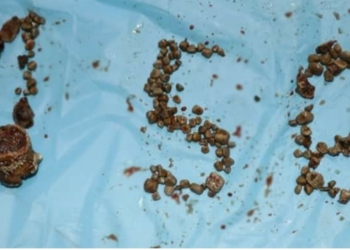 Record 156 Kidney Stones Removed From Single Patient In Hyderabad