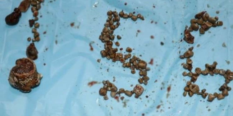 Record 156 Kidney Stones Removed From Single Patient In Hyderabad