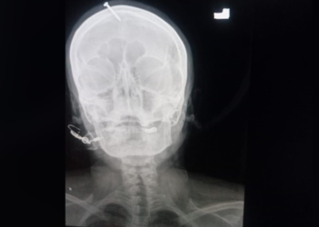 Pregnant Woman had nail hammered into head to ‘guarantee’ birth to baby boy