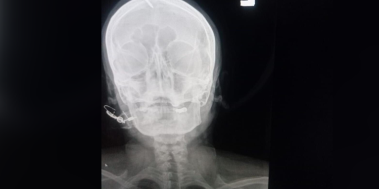 Pregnant Woman had nail hammered into head to ‘guarantee’ birth to baby boy