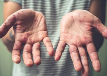 Tomato Flu: Viral Disease Affecting Children; What Are Symptoms And Treatment