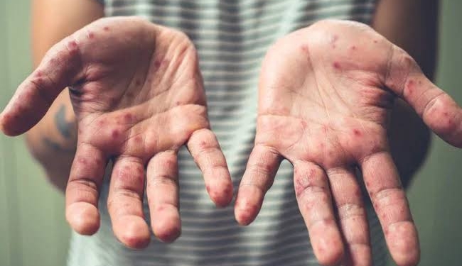 Tomato Flu: Viral Disease Affecting Children; What Are Symptoms And Treatment