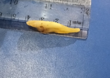 World’s Longest Tooth Extracted From A Patient In Kashmir