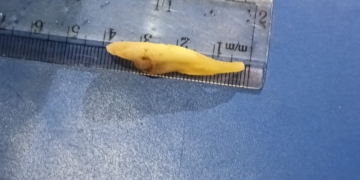 World’s Longest Tooth Extracted From A Patient In Kashmir