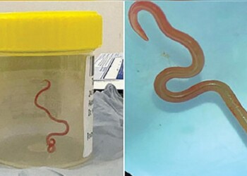 Australian doctors find live parasitic worm in woman’s brain