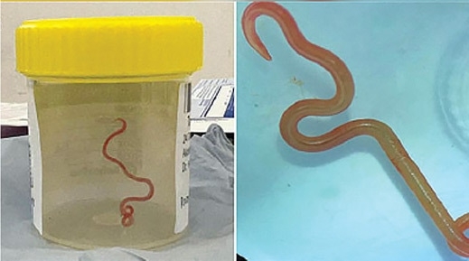 Australian doctors find live parasitic worm in woman’s brain