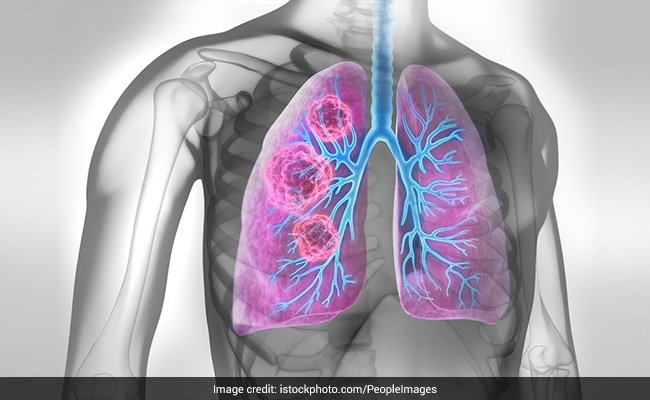 UK Researchers Developing World’s First Lung Cancer Vaccine
