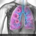 UK Researchers Developing World’s First Lung Cancer Vaccine