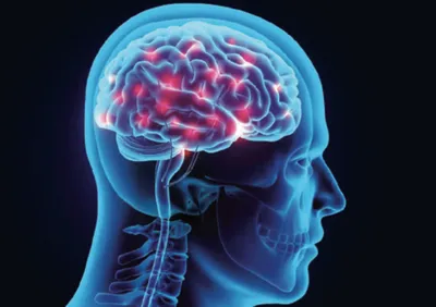 People with aneurysm at high mental health condition risk: Study