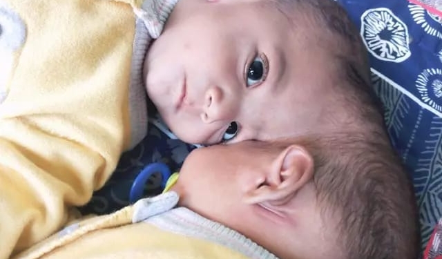 Turkish doctors separate conjoined twins after 14-hour surgery