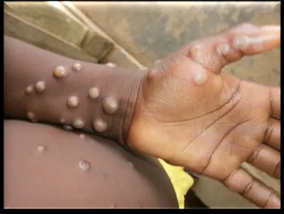 Mpox in India: ‘No need to panic, as chances of Covid-like pandemic is minimal