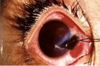 Focusing on Ocular Trauma Prevention and Eye Care in Young People