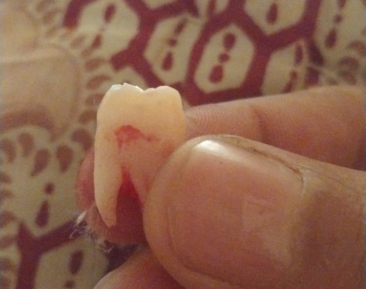 Srinagar Patient Alleges Dental Blunder: Healthy Tooth Extracted Instead of Infected One