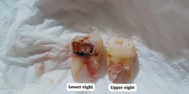 Doctor Suspended for Extracting Healthy Tooth Instead of Infected One